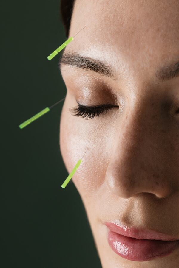 Facial acupuncture needles