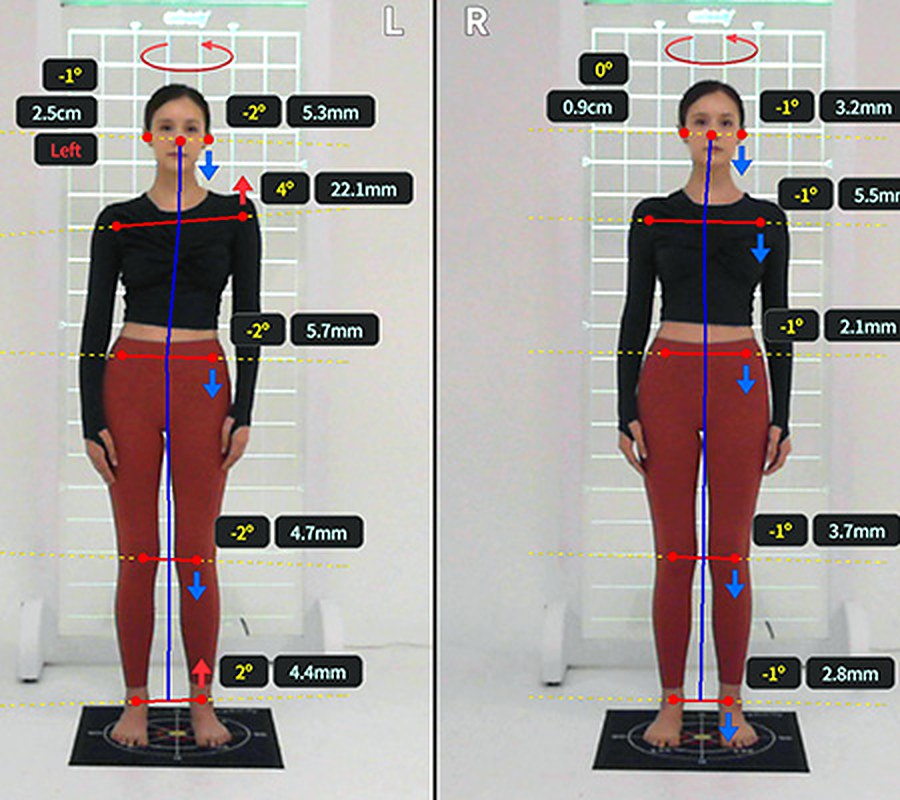 An ExBody posture report: front-view photos with head, shoulder, hip and knee alignment measured in degrees and millimetres